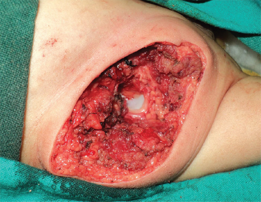 Acetabulum of the parasitic limb hip joint.